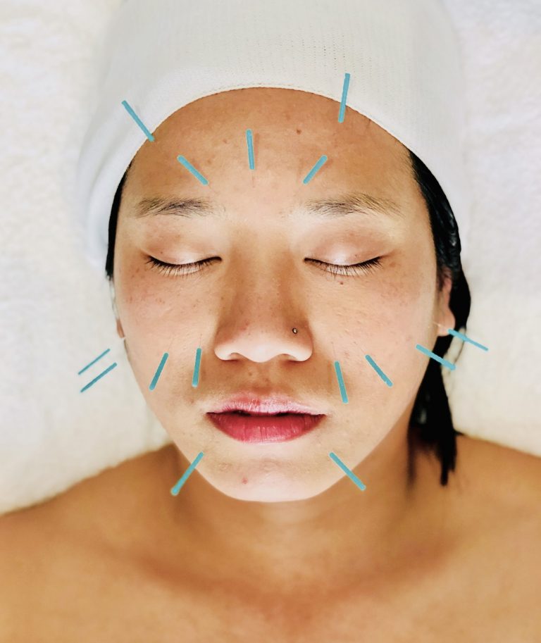 Cosmetic Facial Acupuncture Kirsty Eng