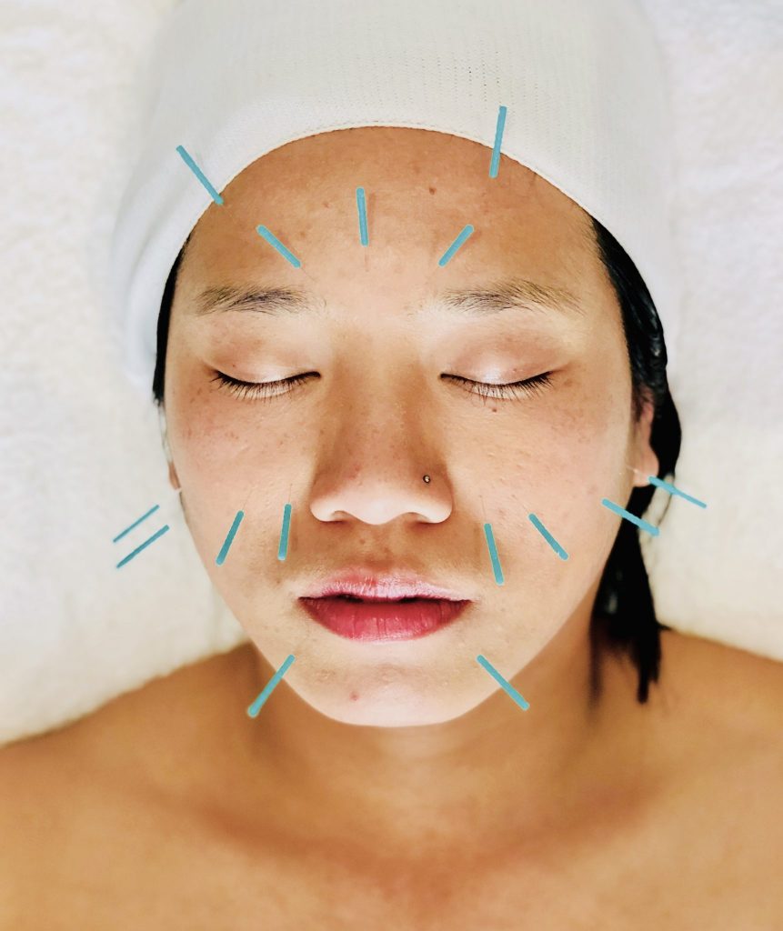 Cosmetic Facial Acupuncture Kirsty Eng